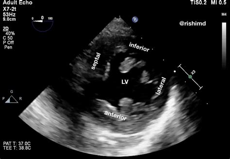 septal wall motion abnormality treatment